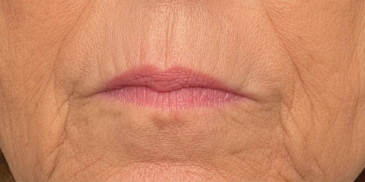 Vorher Botox Mundregion und feine Falten in Hanau
