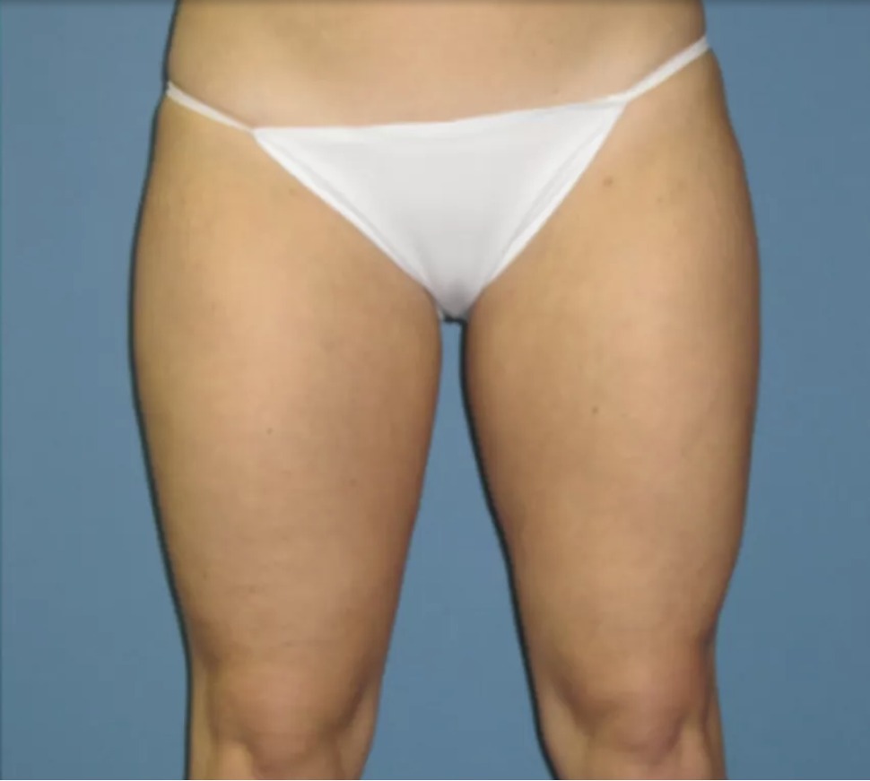 Nachher Cellulite T-Shape Hanau