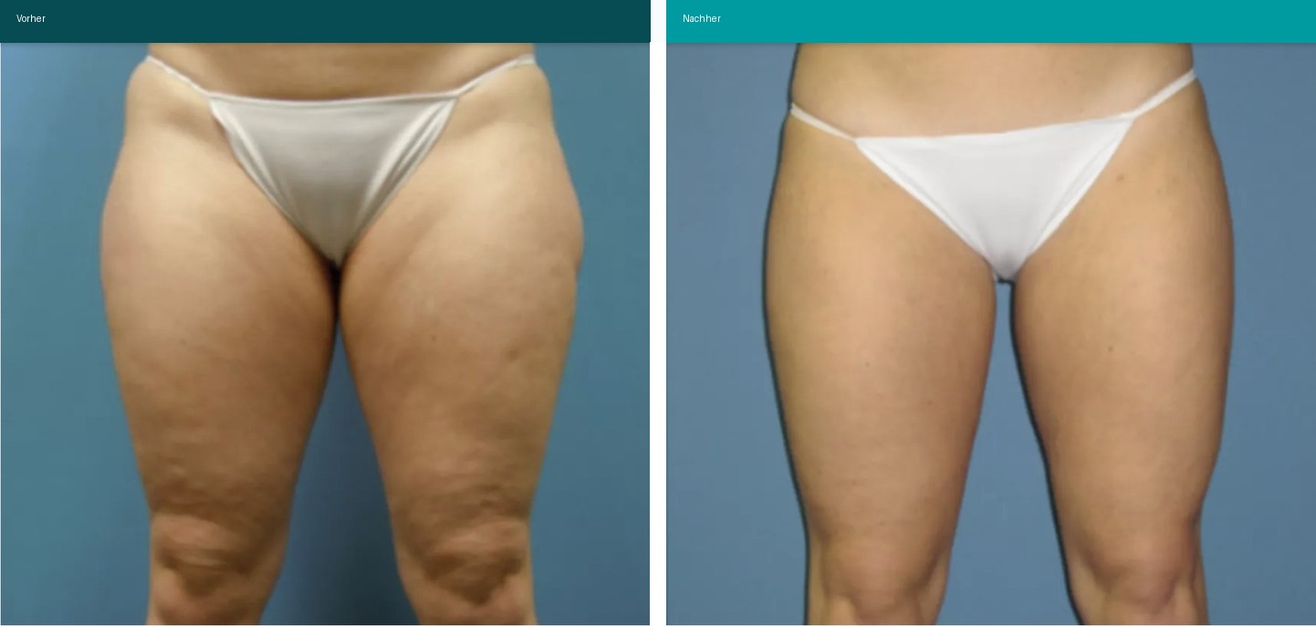 Cellulite / T-Shape Vorher Nachher Hanau