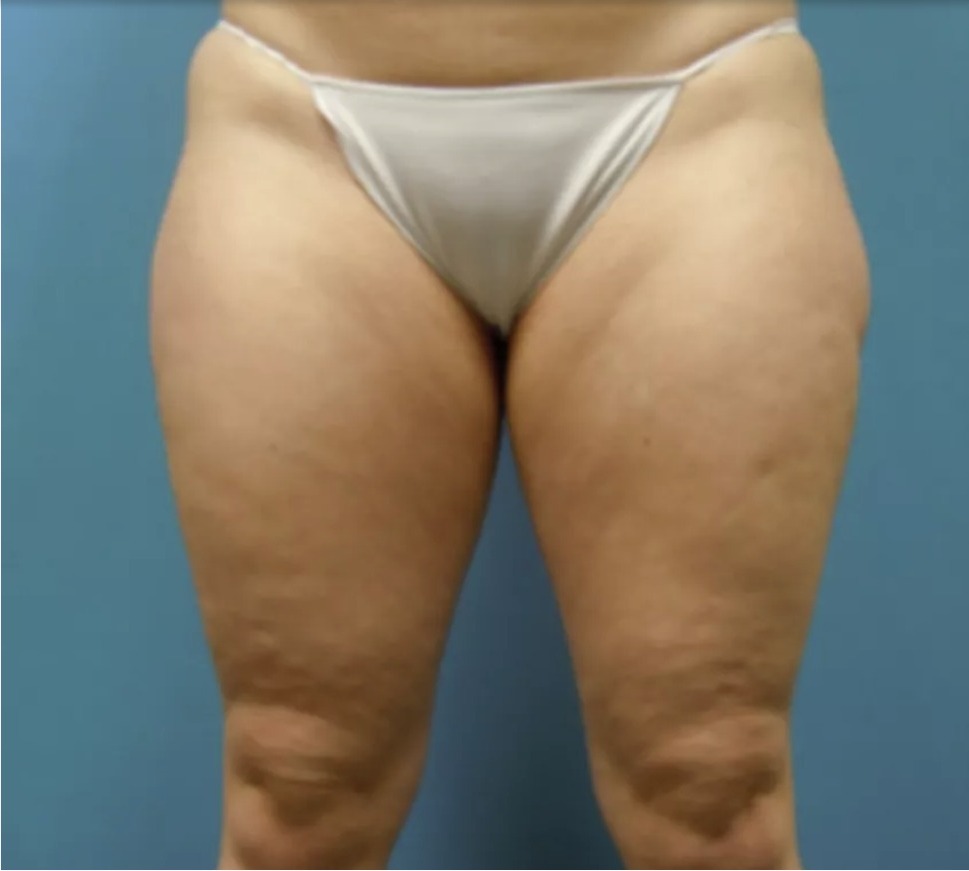 Vorher Cellulite T-Shape Hanau