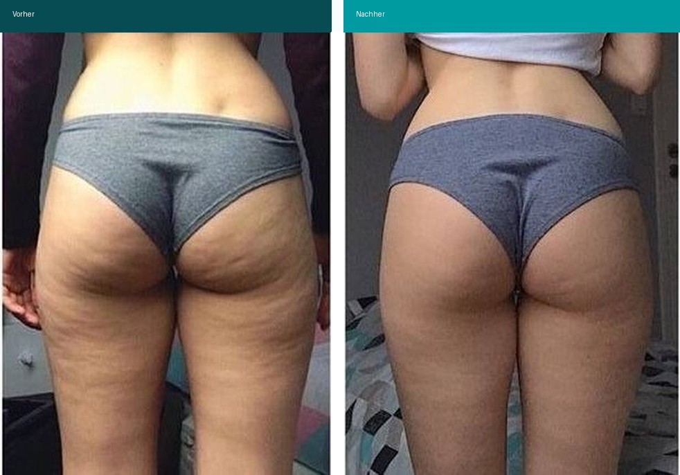 Cellulite / T-Shape Vorher Nachher Hanau
