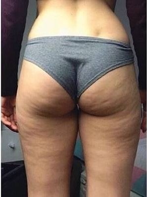 Vorher Cellulite T-Shape Hanau