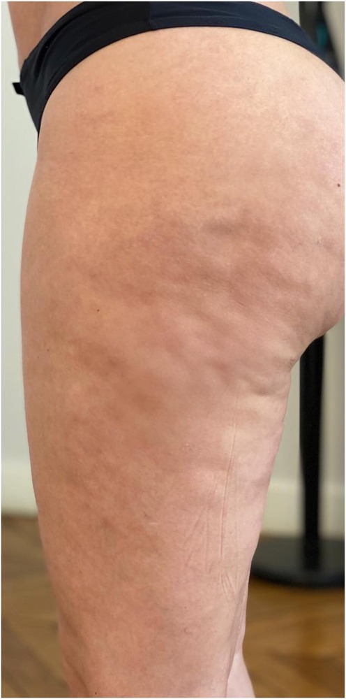 Nachher Cellulite T-Shape Hanau