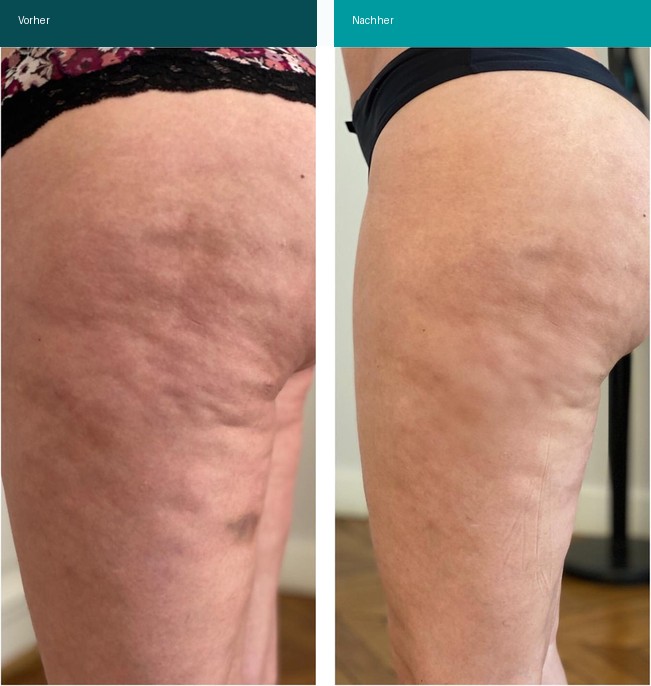 Cellulite / T-Shape Vorher Nachher Hanau