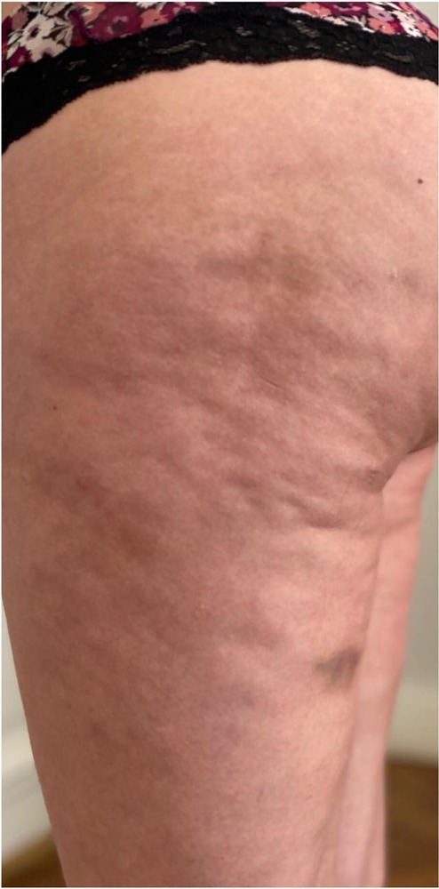 Vorher Cellulite T-Shape Hanau