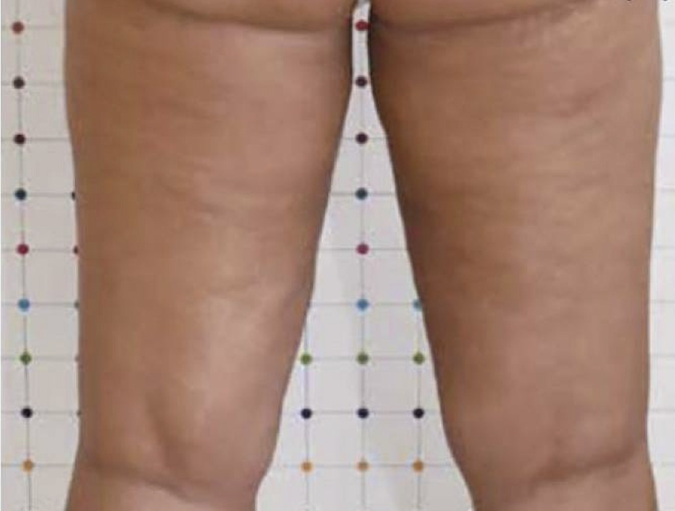 Nachher Cellulite T-Shape Hanau