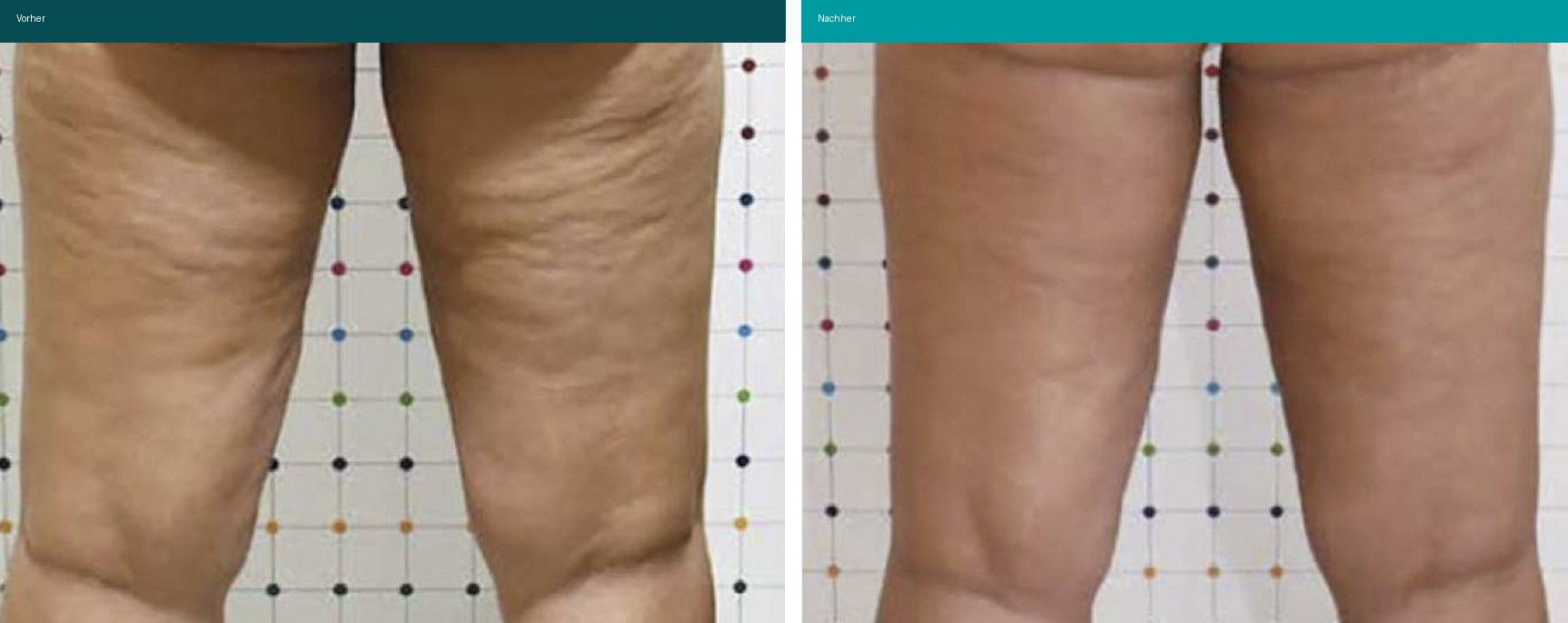 Cellulite / T-Shape Vorher Nachher Hanau
