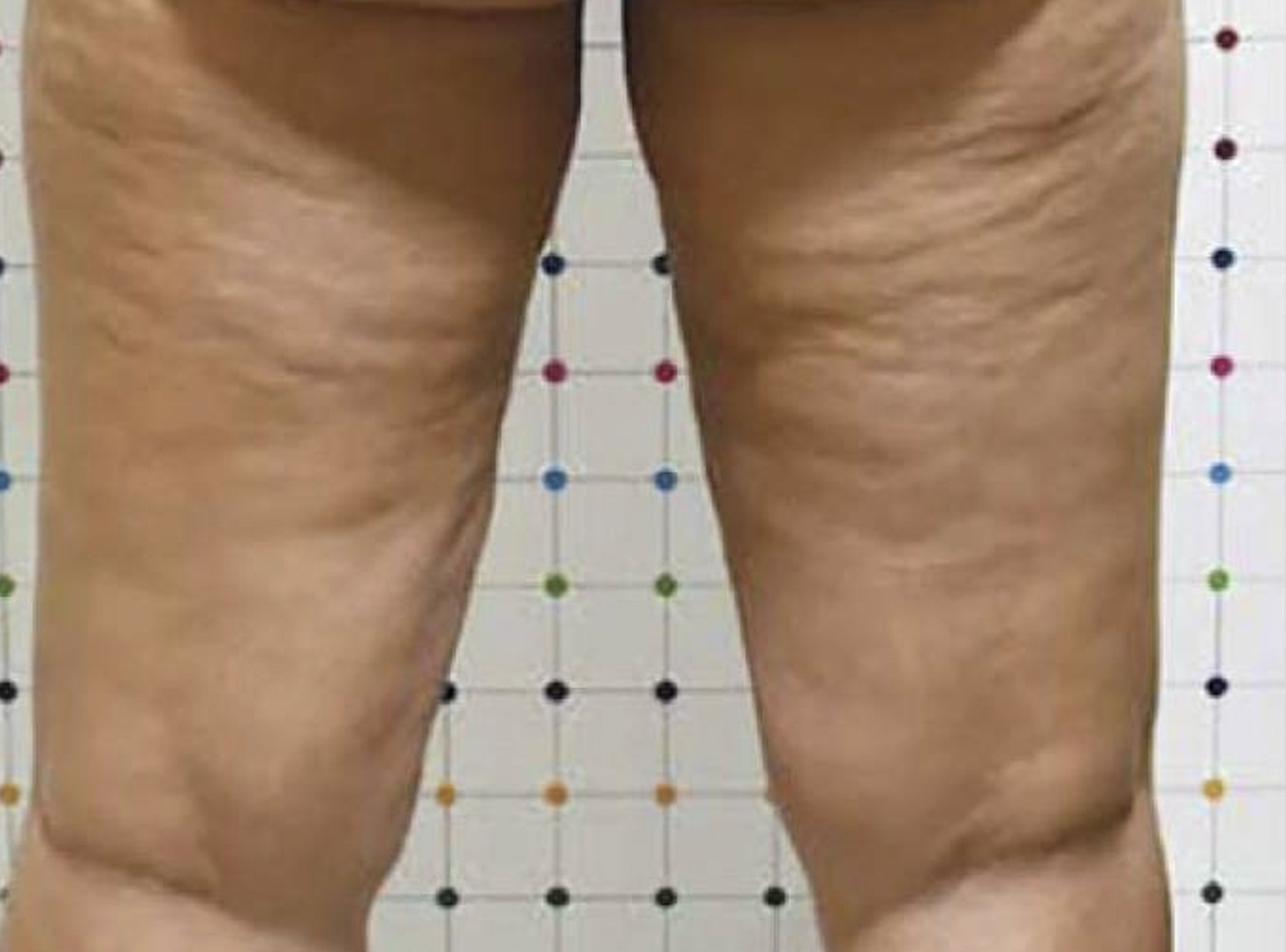 Vorher Cellulite T-Shape Hanau