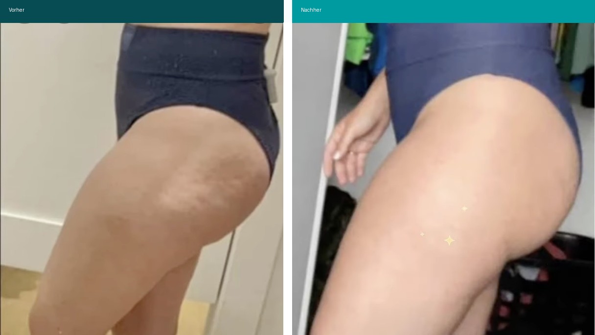 Cellulite / T-Shape Vorher Nachher Hanau