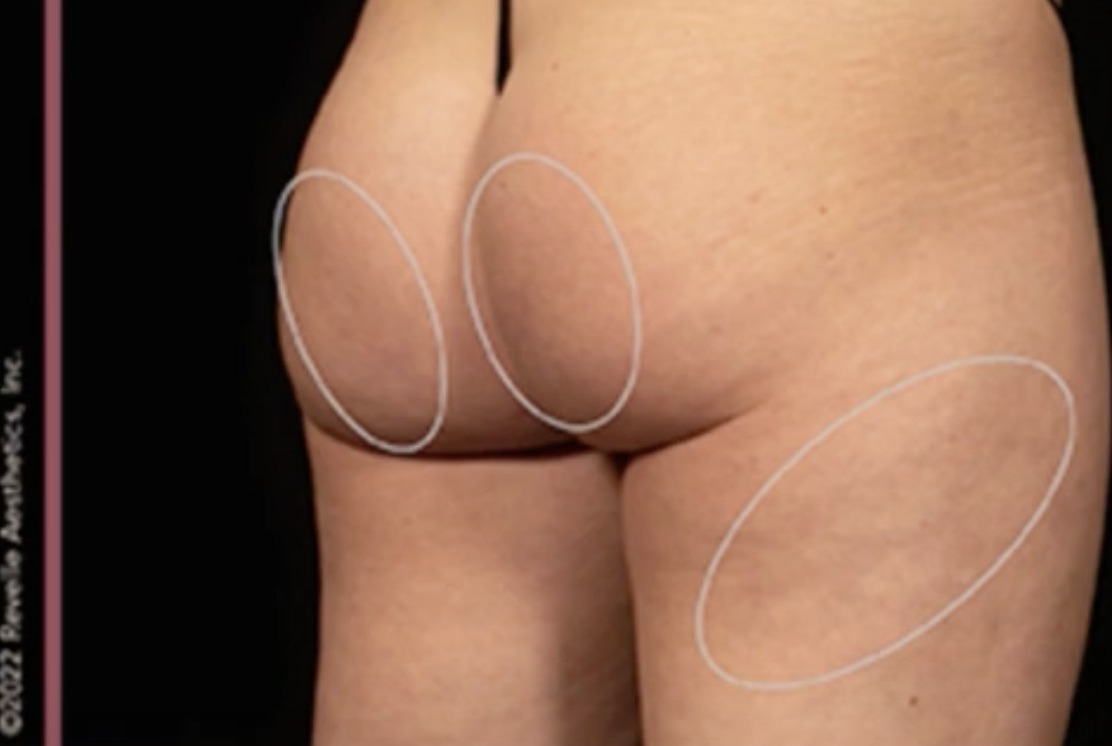Nachher Cellulite T-Shape Hanau