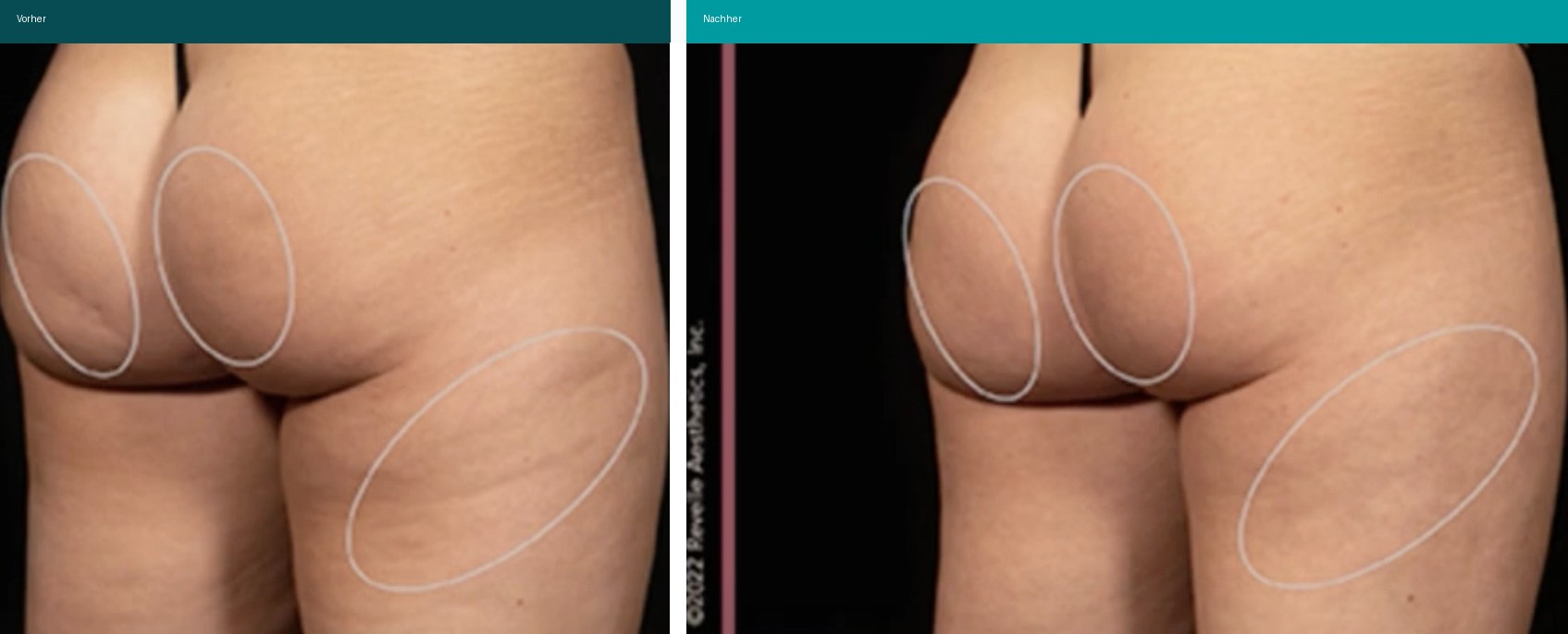 Cellulite / T-Shape Vorher Nachher Hanau