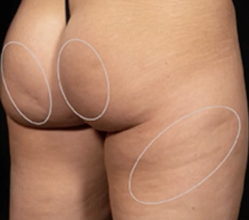 Vorher Cellulite T-Shape Hanau