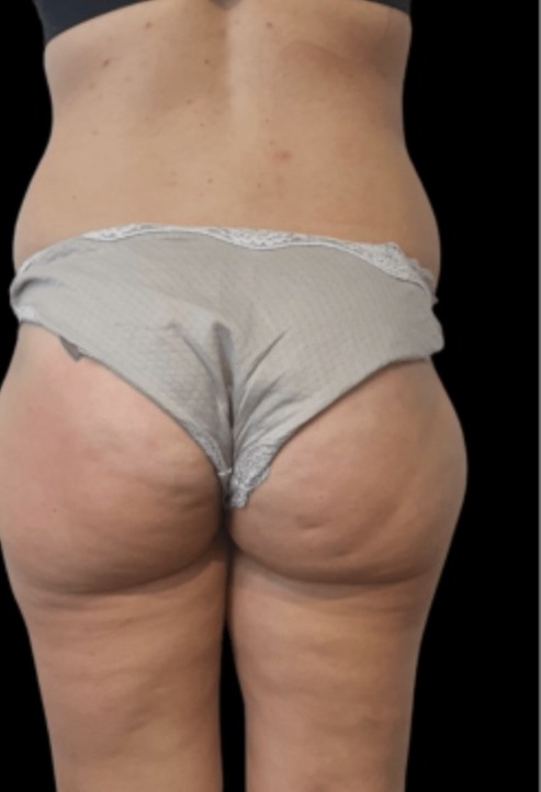 Nachher Cellulite T-Shape Hanau