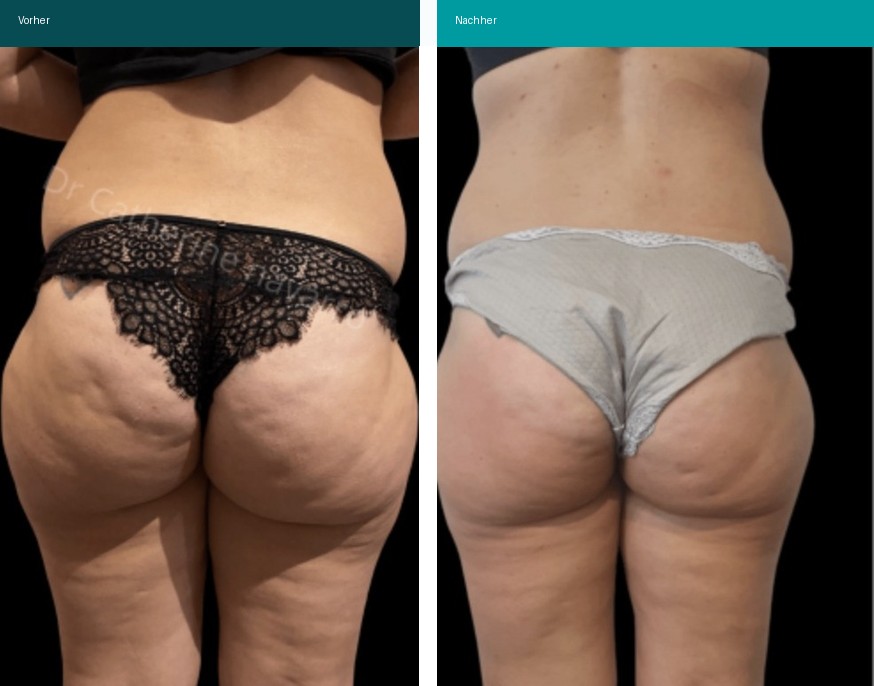 Cellulite / T-Shape Vorher Nachher Hanau