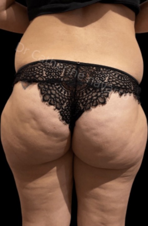 Vorher Cellulite T-Shape Hanau