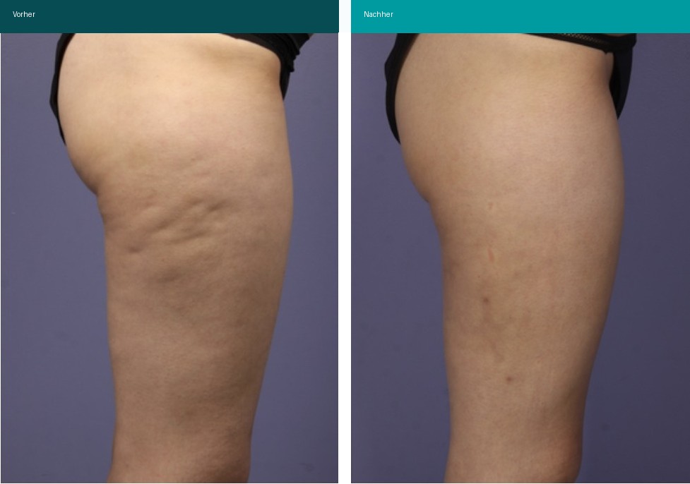 Cellulite / T-Shape Vorher Nachher Hanau