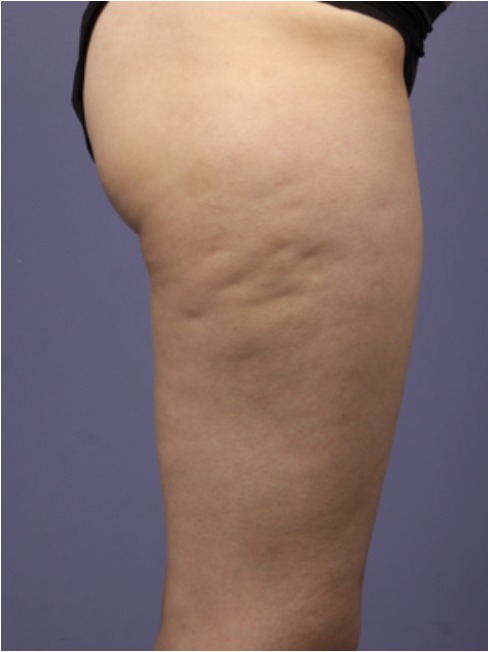 Vorher Cellulite T-Shape Hanau