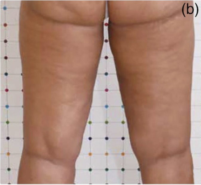 Nachher Cellulite T-Shape Hanau