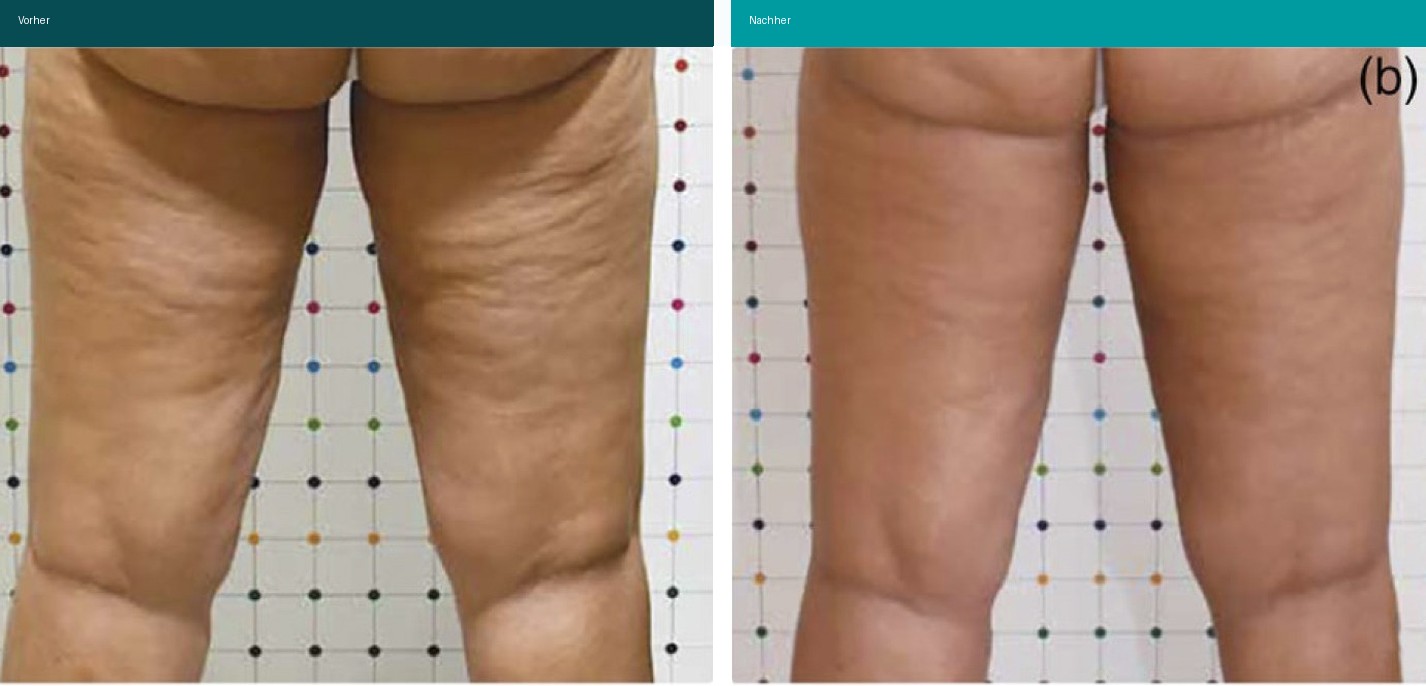 Cellulite / T-Shape Vorher Nachher Hanau