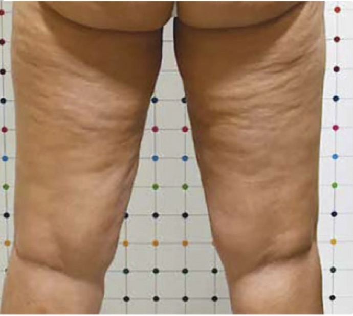 Vorher Cellulite T-Shape Hanau