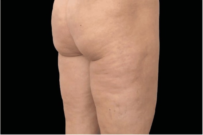 Nachher Cellulite T-Shape Hanau