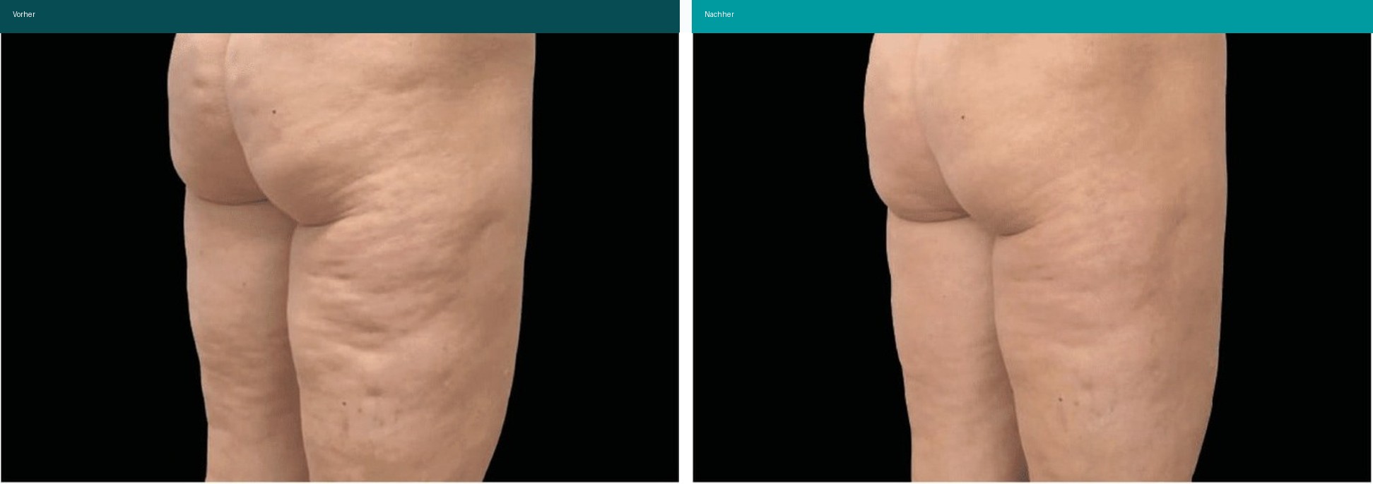 Cellulite / T-Shape Vorher Nachher Hanau