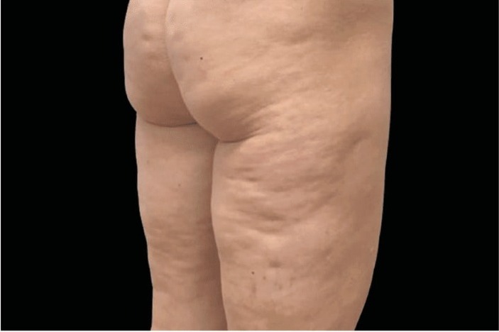 Vorher Cellulite T-Shape Hanau