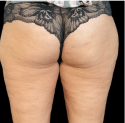 Nachher Cellulite T-Shape Hanau