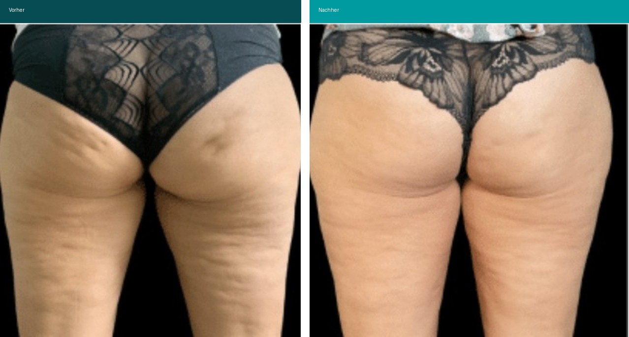 Cellulite / T-Shape Vorher Nachher Hanau