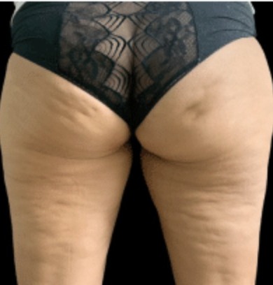 Vorher Cellulite T-Shape Hanau