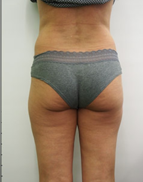 Nachher Cellulite T-Shape Hanau