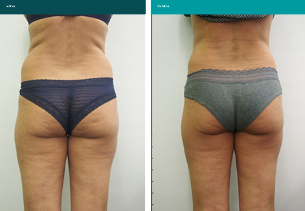 Cellulite / T-Shape Vorher Nachher Hanau