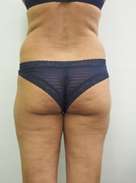 Vorher Cellulite T-Shape Hanau
