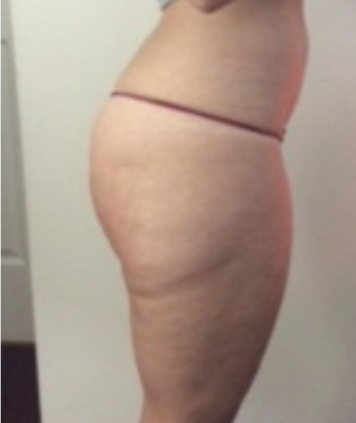 Nachher Cellulite T-Shape Hanau
