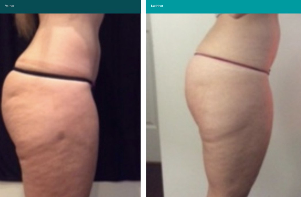 Cellulite / T-Shape Vorher Nachher Hanau