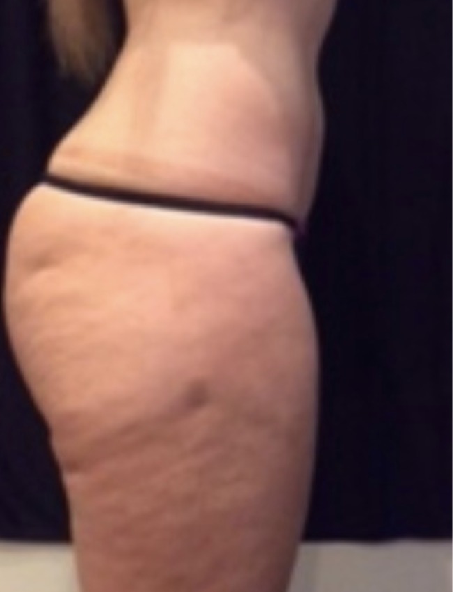 Vorher Cellulite T-Shape Hanau