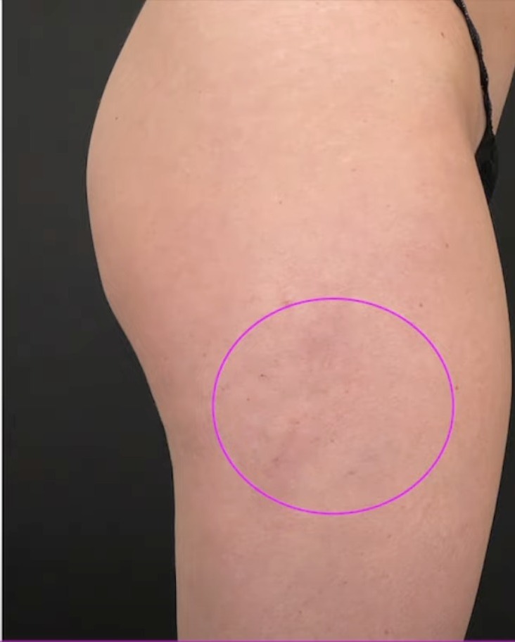 Nachher Cellulite T-Shape Hanau