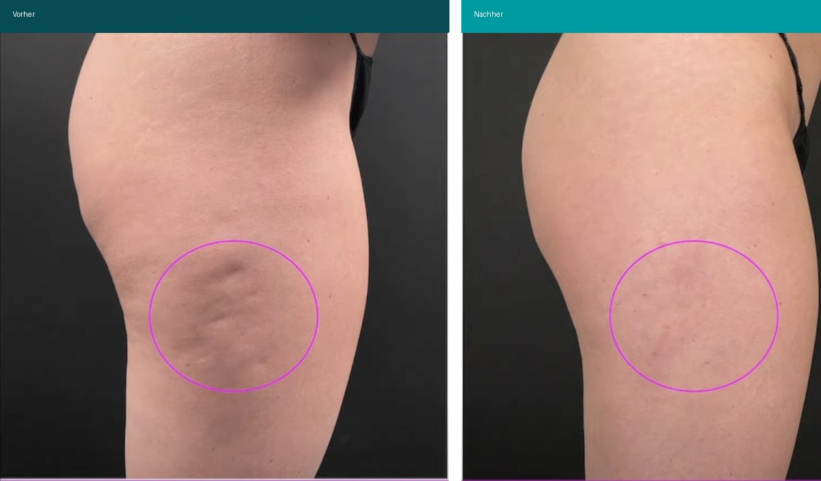 Cellulite / T-Shape Vorher Nachher Hanau