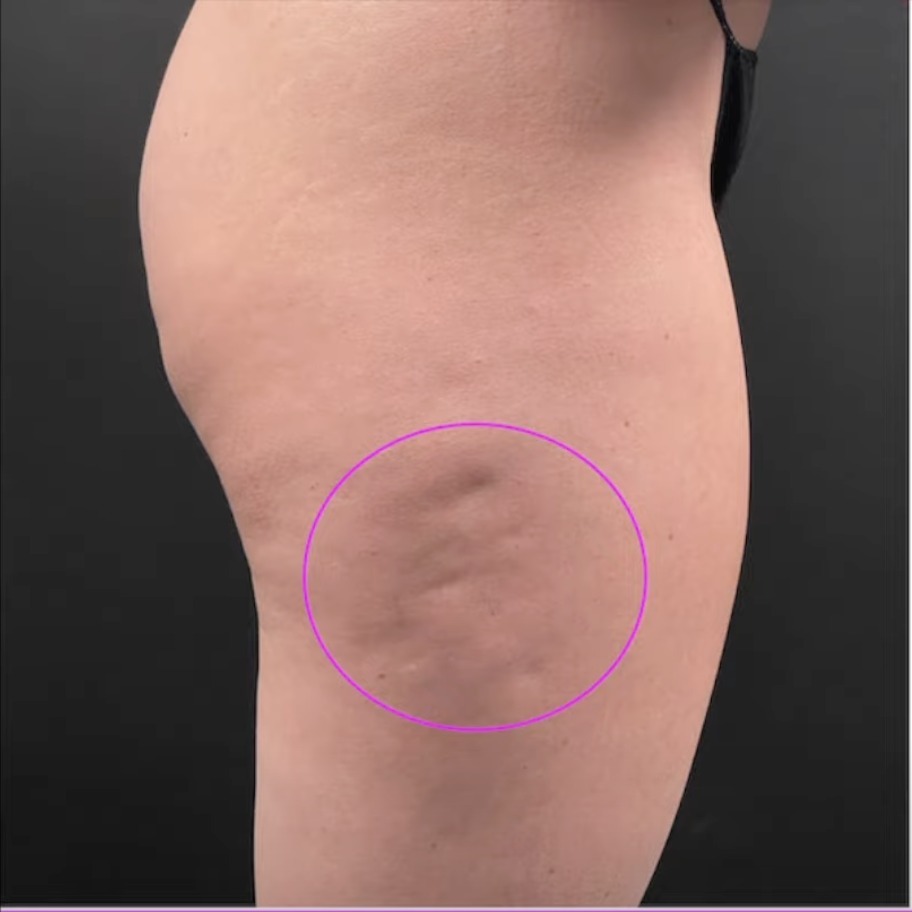Vorher Cellulite T-Shape Hanau