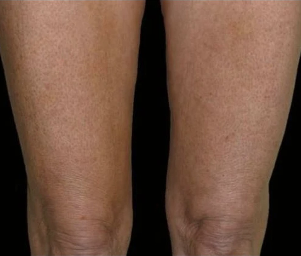 Nachher Cellulite T-Shape Hanau