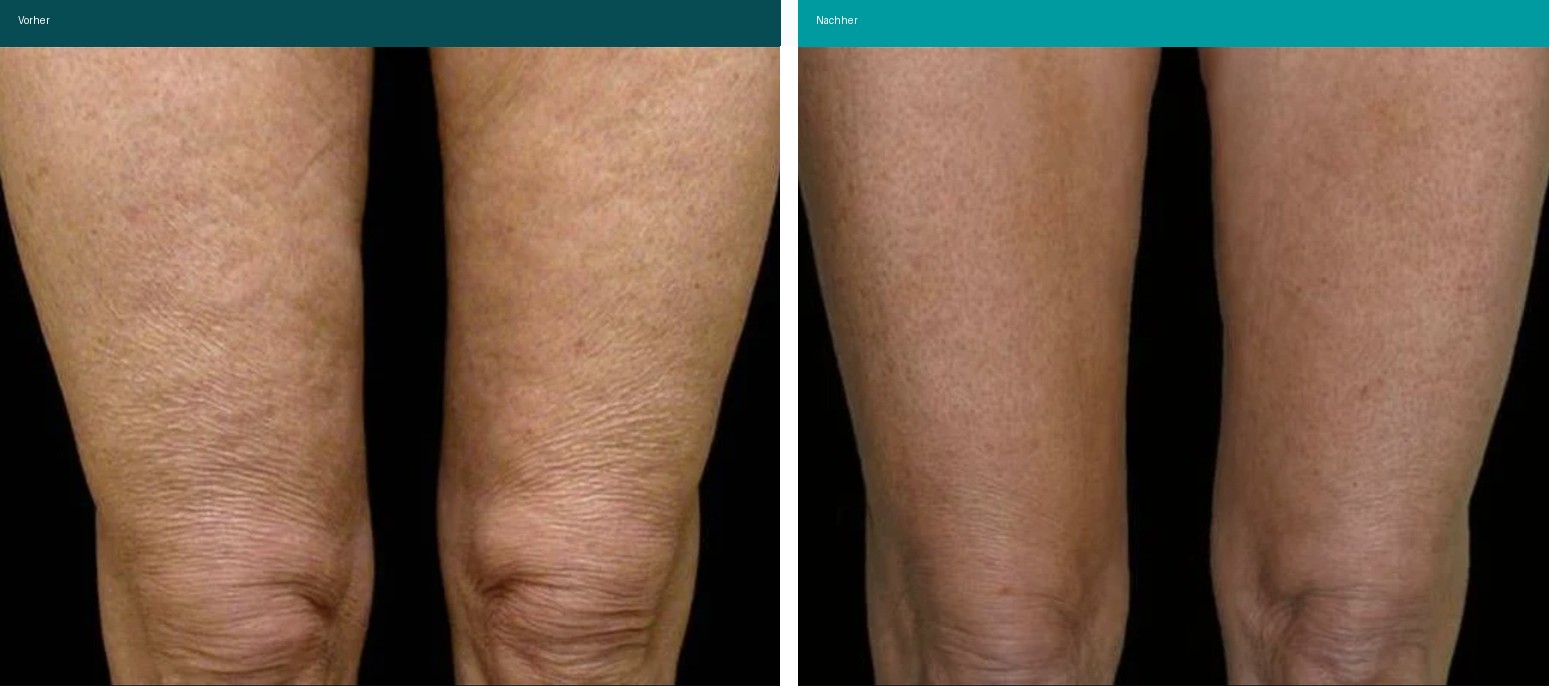 Cellulite / T-Shape Vorher Nachher Hanau