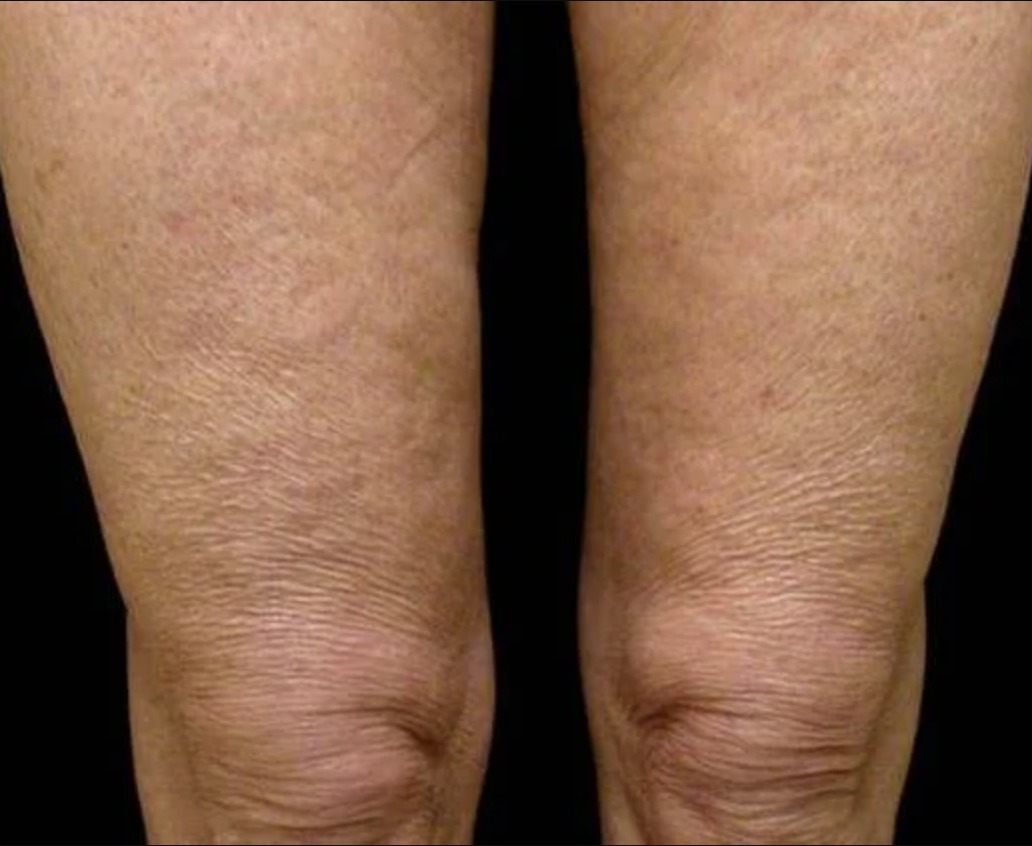 Vorher Cellulite T-Shape Hanau