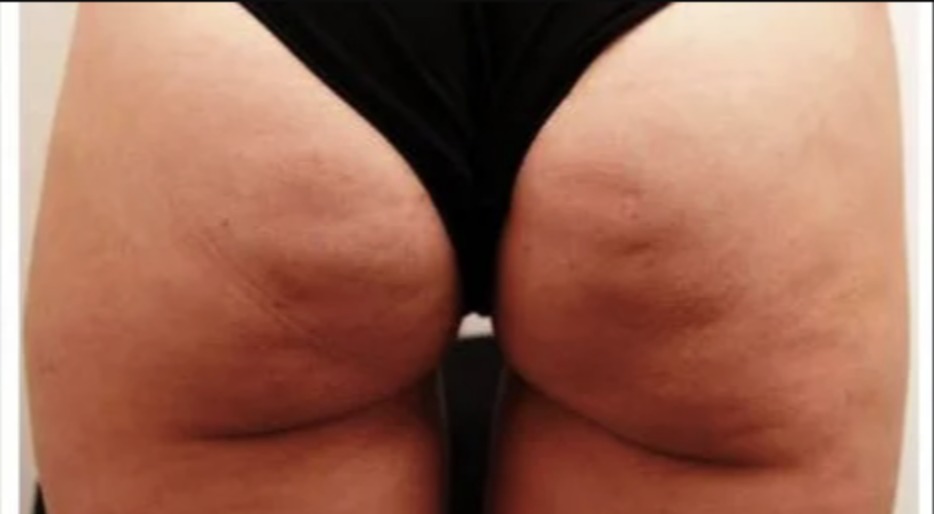Nachher Cellulite T-Shape Hanau