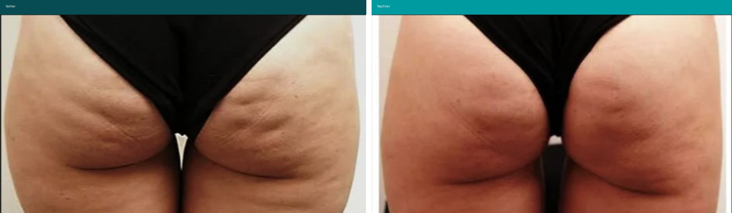 Cellulite / T-Shape Vorher Nachher Hanau