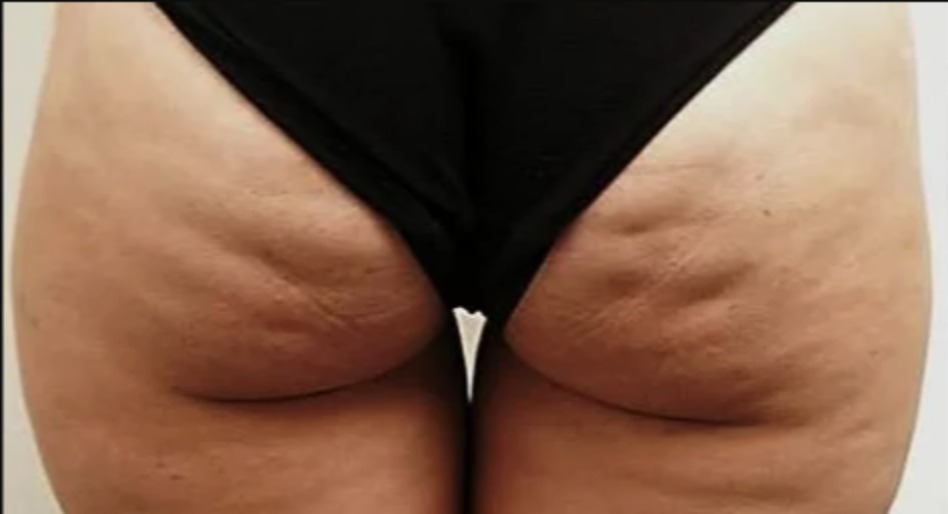 Vorher Cellulite T-Shape Hanau