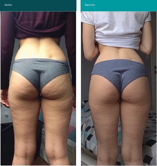 Cellulite / T-Shape Vorher Nachher Hanau