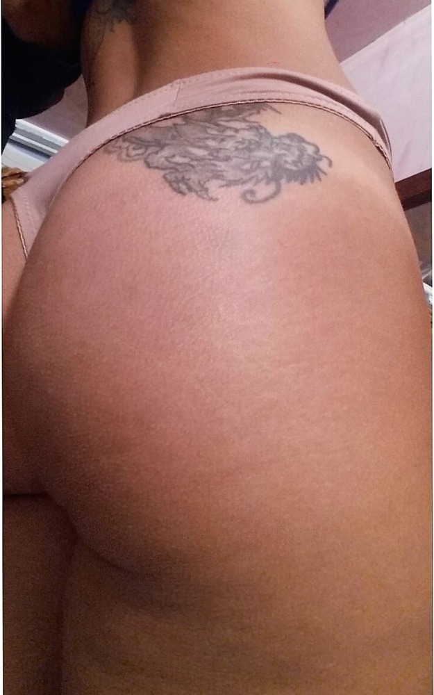 Nachher Cellulite T-Shape Hanau