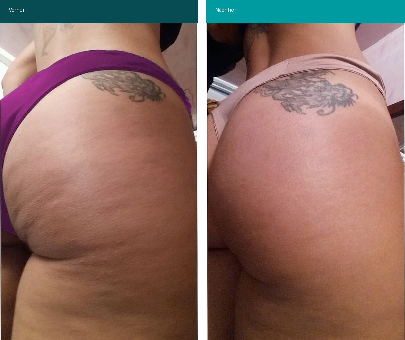 Cellulite / T-Shape Vorher Nachher Hanau