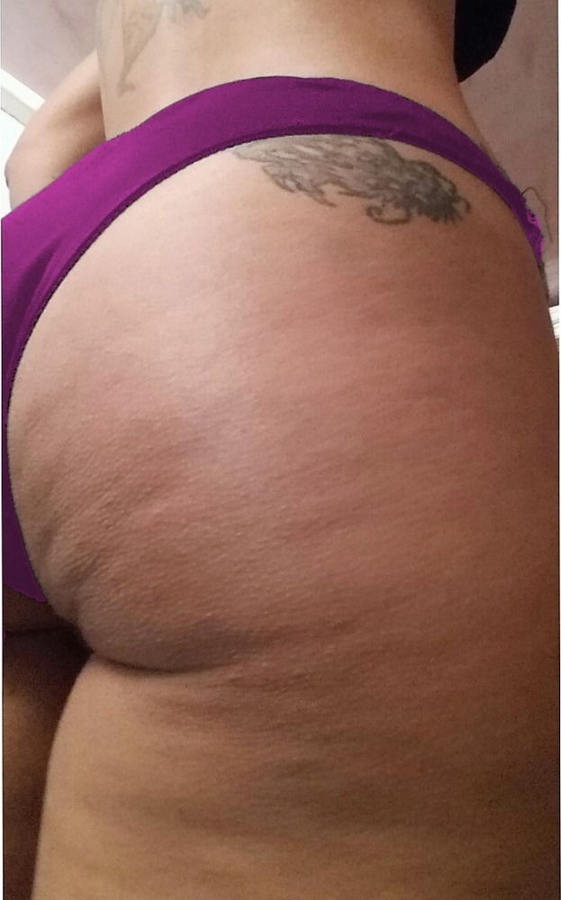 Vorher Cellulite T-Shape Hanau