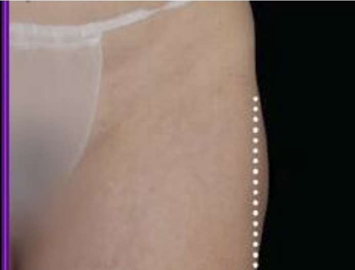 Nachher Cellulite T-Shape Hanau